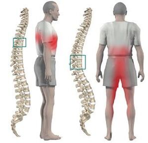 Pain bi chondrosis thoracic re dibe ku ji lehî û xalîçeya jêrîn were dayîn