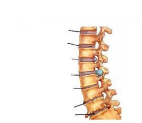 Nîşaneyên osteochondrosis