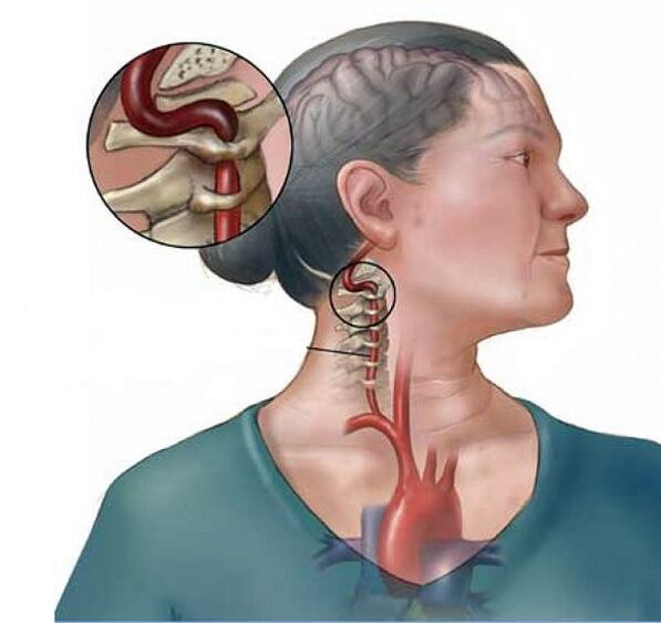 sendroma arteria vertebral bi osteochondrosis malzaroka malzarokê