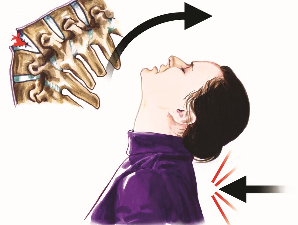 zirara stûyê wekî sedema êşa stûyê