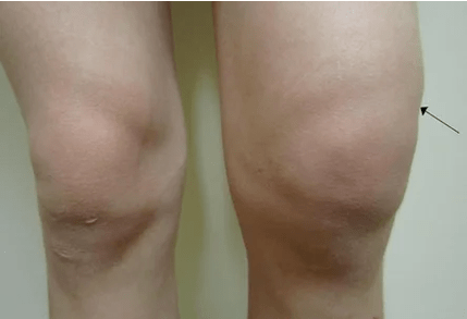 Hemarthrosis movika çokê